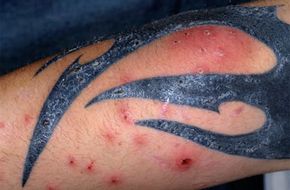 What Causes A Tattoo to Get Infected