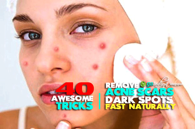 Remove Acne Scars, Dark Spots Fast - 40 Best Natural Home 
