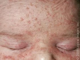 Neonatal Acne - Baby Acne 