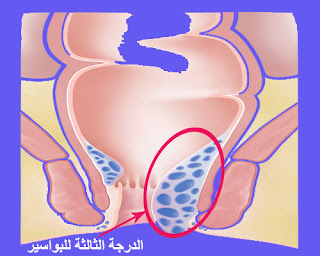 تعرف على شكل البواسير الداخلية بالصور الحقيقية