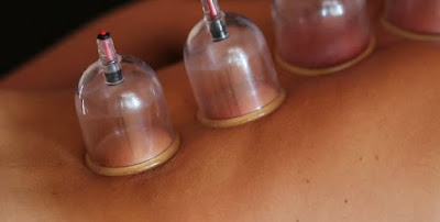 cupping therapy, cupping therapy benefits, cupping therapy points, blog, cupping therapy at home,cupping therapy near me, cupping therapy price, wet cupping hijama,hijama therapy, cupping uses, cupping benefits