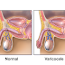 Jenis Obat Untuk Mengatasi Masalah Testis Bengkak