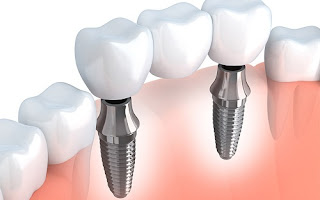 Thời gian cấy răng Implant mất bao lâu?