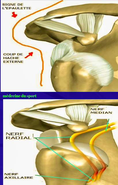 Les Luxations de l’épaule