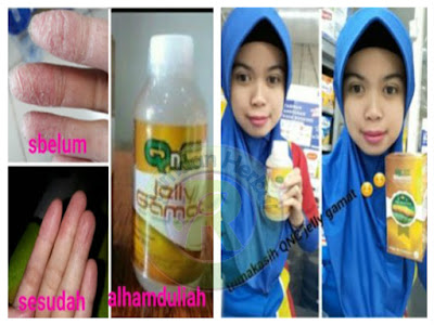 Pengobatan Kulit Bersisik, Kering Dan Gatal (Psoriasis)