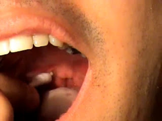 Tonsil Stones Homeopathic Treatment : Tonsil Stones Treatment - Do It Yourself Or Go To The Doctor