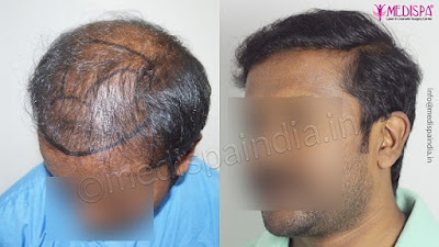 hair transplant in jaipur