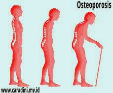 Tulang keropos atau Osteoporosis