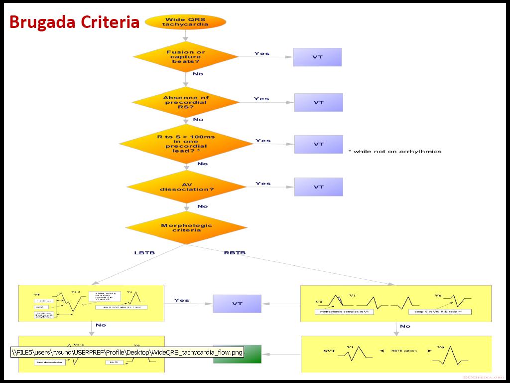 Brugada%2BCriteria_Picture