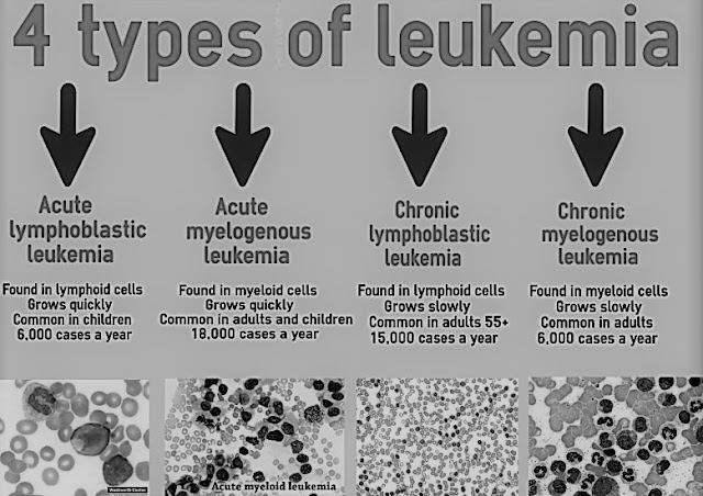 Leukemia Types And Stages