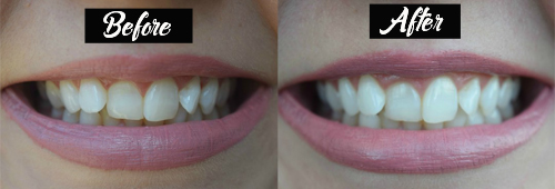 How to whiten your teeth naturally in just 3 minutes