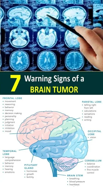 7 warning signs of a brain tumor