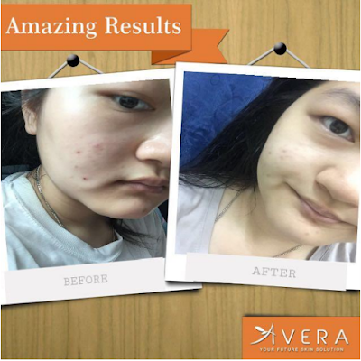 avera acne serum, jerawat hilang, jerawat surut, cara hilangkan jerawat, review avera acne serum