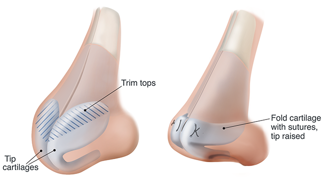 http://www.gvent.net/conditions/nose-rhinology/