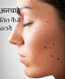 How to Remove Til or Mole From Face at Home in Hindi  तिल व मस्से