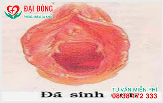 hình ảnh màng trinh bị rách