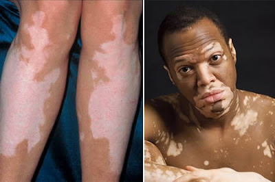 Dangerous Skin Diseases