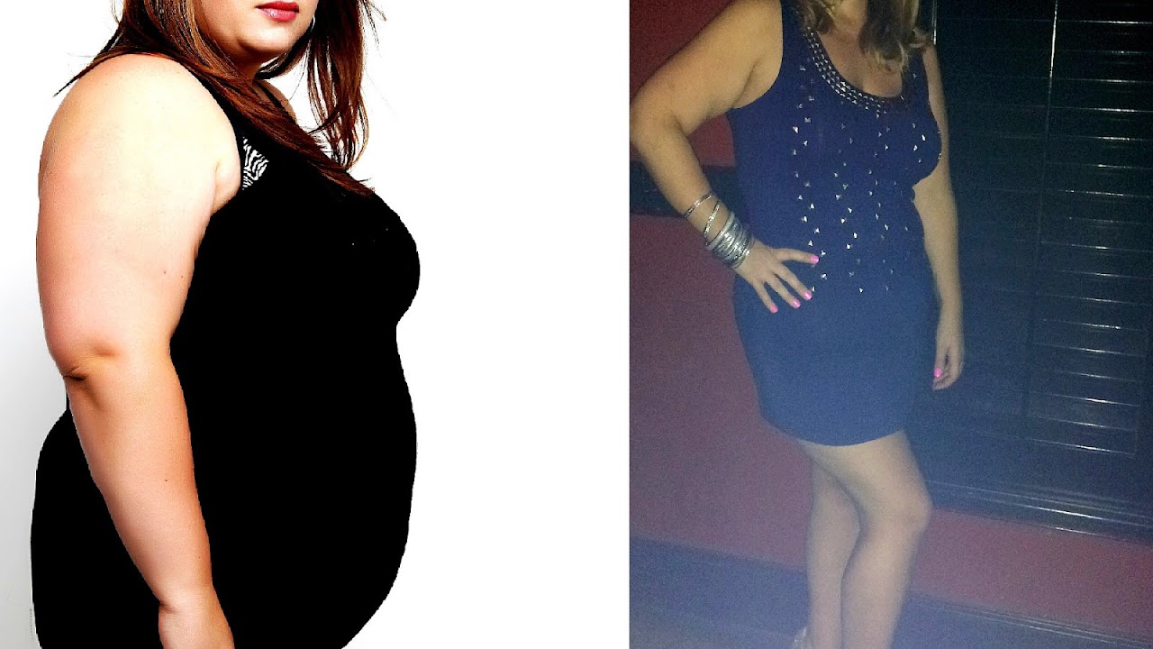 Side Effects Gastric Sleeve