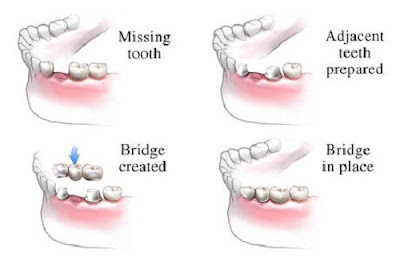 Ưu và nhược điểm của cầu răng sứ 