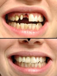 dental implants