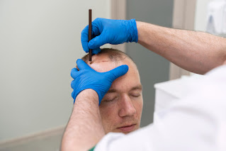 FUE Hair Transplant Brisbane