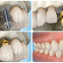 Quy trình tiến hành cấy ghép răng Implant 