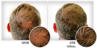 Provillus hair loss treatment 