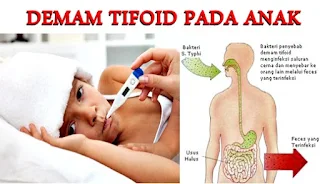 Mengobati dan Mencegah Penyakit Demam Tifoid