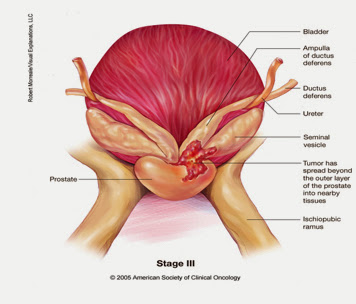 Stage III  (stage C) Prostate cancer