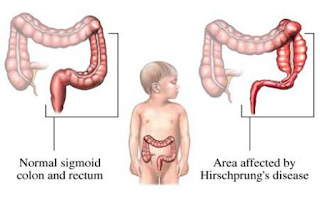 Hirschsprung's Disease Symptoms And Treatment