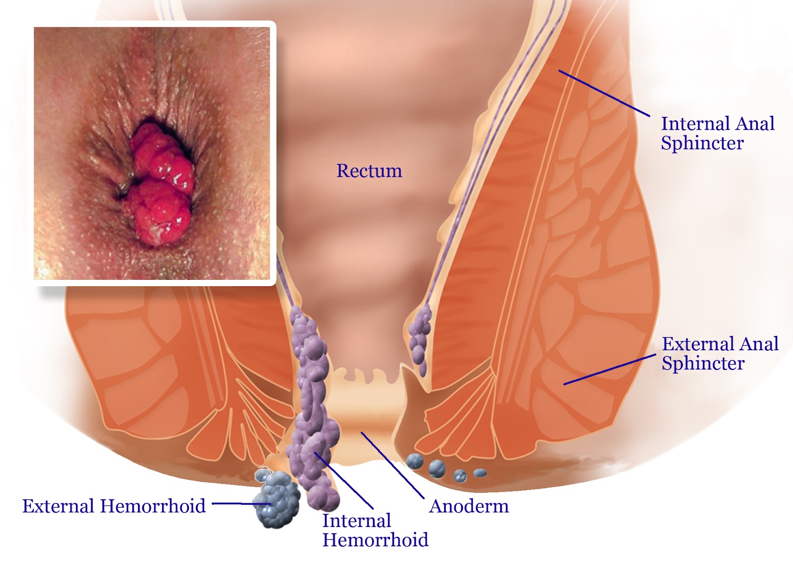 Define hemorrhoids hemorrhoids alleviation