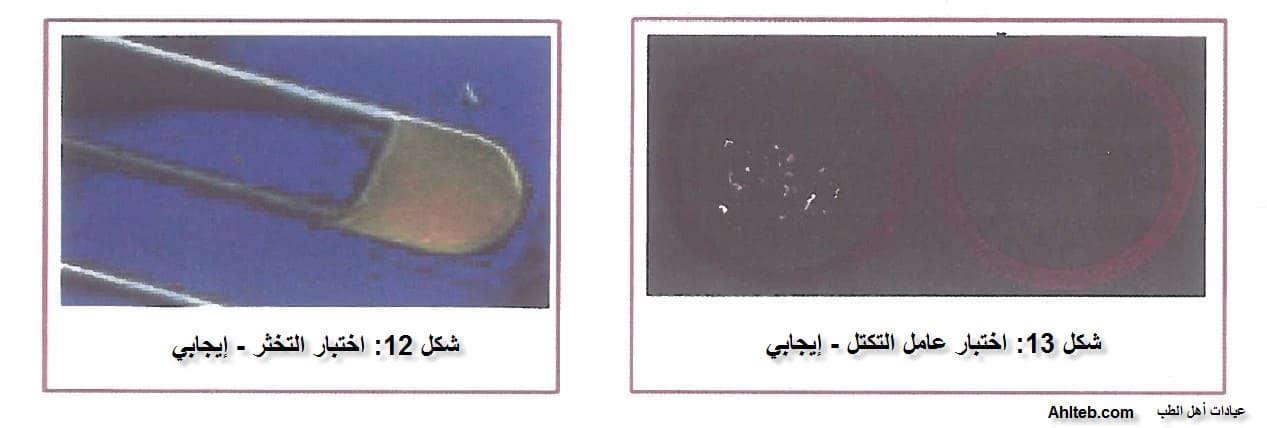 اختبار التخثر عامل التكتل