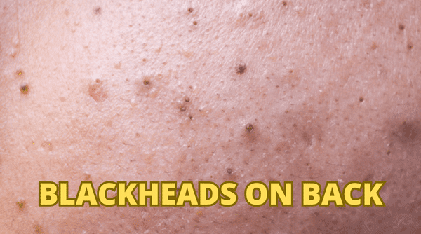 Blackheads on Back | Blackheads and whiteheads