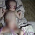 Heboh Di India, Bayi Mirip Alien, Lahir Tanpa Hidung Dan Telinga