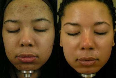 Skin Lightening Cream Before After