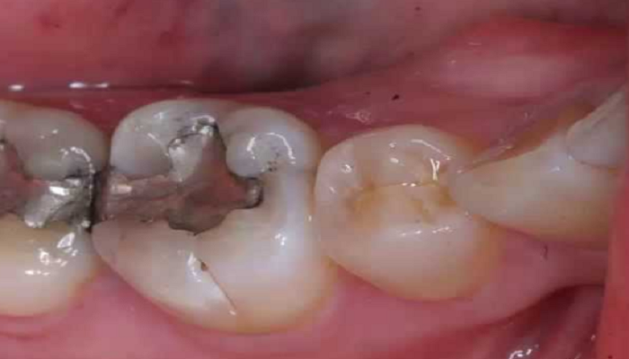 Zahnschmerzen Nach Fullung Gebrochene Zahne Schmerzen