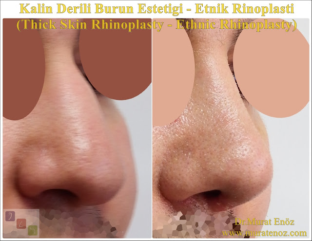 Kalın derili burun estetiği algoritması - Kalın derili rinoplasti - Thick skin rhinoplasty in İstanbul - Kalın derili burun estetiği teknikleri - Kalın derili burun estetiği nasıl yapılır? - Kalın derili burun estetiği en iyi teknik hangisidir? - Rhinoplasty in İstanbul - Thick skin nose job - Etnik burun estetiği - Ethnic rhinoplasty - Ethnic nose job in İstanbul, Turkey