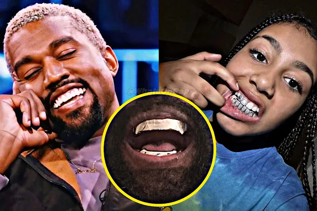 North West Shines with Diamond Grills as Kanye Unveils $850K Titanium Dentures: The Wests' Dazzling Dental Revelations.