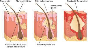 What causes hormonal  skin inflammation