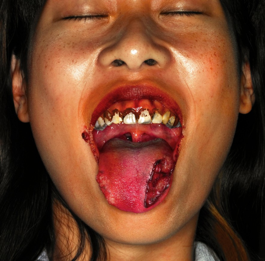 ulcers on tongue. varibar, Mouth+ulcers+on+