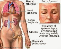 Obat Alami Penyakit Lupus, Gejala dan Penyebabnya