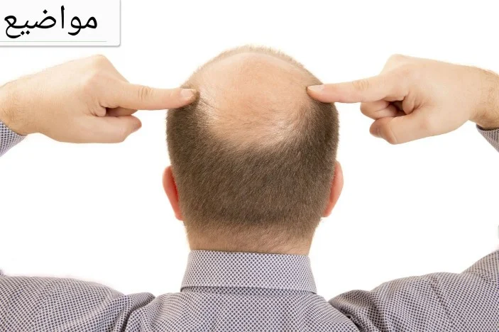 يصيب الصلع الرجال أكثر من النساء، حيث يبدأ الشعر بالتساقط تدريجياً حتى الوصول إلى الصلع، ومقدمة الرأس هي المكان الأكثر عرضة له، وتزاد فرصة الإصابة بالصلع لدى كبار السنّ خصوصاً بعد سنّ الثمانين