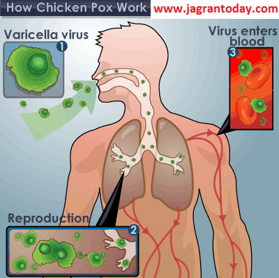 चिकनपॉक्स के लिए करें ये उपचार