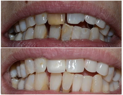 Treatment of Discolored Tooth with E-Max Crown