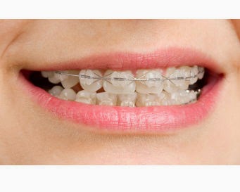  Harga  Pemasangan Behel  Gigi  Kawat Gigi  Dokter Gigi 