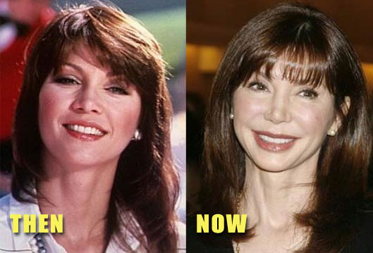 Victoria Principal before and after plastic surgery.