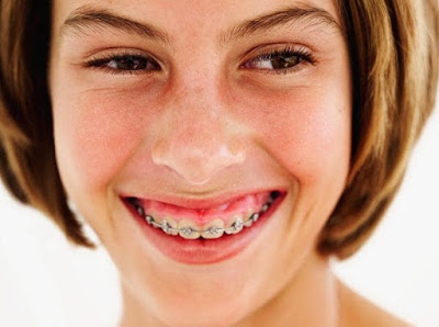 Quy trình niềng răng không nhổ răng 