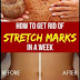 How To Get Rid Of Stretch Marks In A Week