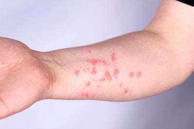 Monkeypox – Symptoms and Causes