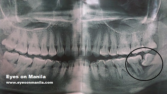 X-ray of my impacted tooth 